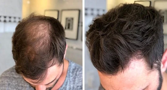 Beste recensies van ???? IMPERIO Premium Haarvezels Donkerbruin - Kaalheid Mannen - Alopecia Vrouwen - 100% Onzichtbaar ???? 16 Beste recensies van ???? IMPERIO Premium Haarvezels Donkerbruin - Kaalheid Mannen - Alopecia Vrouwen - 100% Onzichtbaar ???? - Afbeelding 16