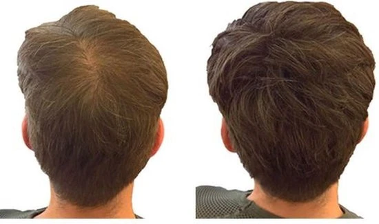 Beste recensies van ???? IMPERIO Premium Haarvezels Donkerbruin - Kaalheid Mannen - Alopecia Vrouwen - 100% Onzichtbaar ???? 15 Beste recensies van ???? IMPERIO Premium Haarvezels Donkerbruin - Kaalheid Mannen - Alopecia Vrouwen - 100% Onzichtbaar ???? - Afbeelding 15