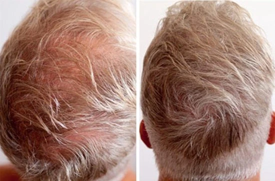 Beste recensies van ???? IMPERIO Premium Haarvezels Donkerbruin - Kaalheid Mannen - Alopecia Vrouwen - 100% Onzichtbaar ???? 18 Beste recensies van ???? IMPERIO Premium Haarvezels Donkerbruin - Kaalheid Mannen - Alopecia Vrouwen - 100% Onzichtbaar ???? - Afbeelding 18