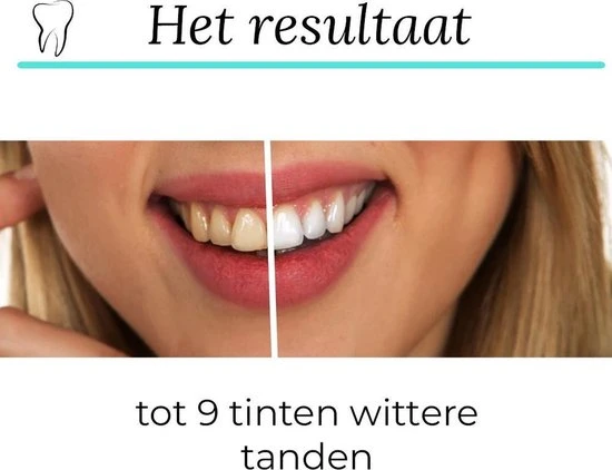 Groothandel ???? SmileKit Teeth Whitening Strips - Tanden Bleken - Tandenbleekset - Tandenbleek Strips - 100% Natuurlijk/Vegan - 28x Tandenbleek Strips - (0%) Peroxide - Activated Houtskool & Kokosolie - Beauty - Frisse Adem ???? 5 Groothandel ???? SmileKit Teeth Whitening Strips - Tanden Bleken - Tandenbleekset - Tandenbleek Strips - 100% Natuurlijk/Vegan - 28x Tandenbleek Strips - (0%) Peroxide - Activated Houtskool & Kokosolie - Beauty - Frisse Adem ???? - Afbeelding 5