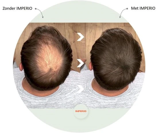 Beste recensies van ???? IMPERIO Premium Haarvezels Donkerbruin - Kaalheid Mannen - Alopecia Vrouwen - 100% Onzichtbaar ???? 9 Beste recensies van ???? IMPERIO Premium Haarvezels Donkerbruin - Kaalheid Mannen - Alopecia Vrouwen - 100% Onzichtbaar ???? - Afbeelding 9