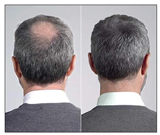 Beste recensies van ???? IMPERIO Premium Haarvezels Donkerbruin - Kaalheid Mannen - Alopecia Vrouwen - 100% Onzichtbaar ???? 12 Beste recensies van ???? IMPERIO Premium Haarvezels Donkerbruin - Kaalheid Mannen - Alopecia Vrouwen - 100% Onzichtbaar ???? - Afbeelding 12