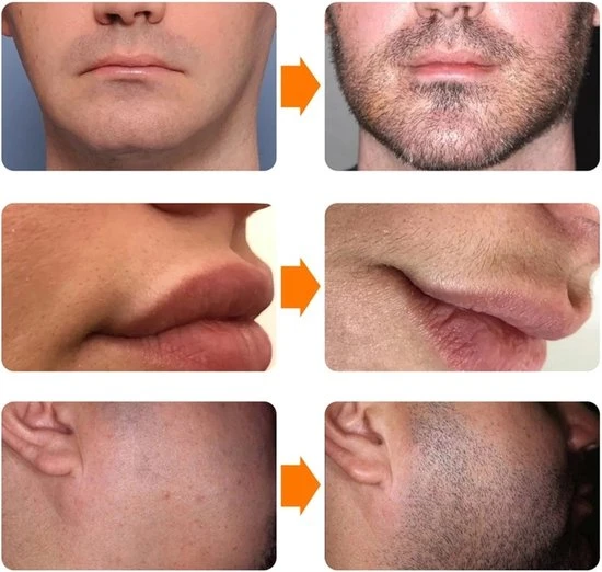 Goedkoopste ???? Growfast™ Baardgroei Olie - Activator Serum - Baardolie ???? 2 Goedkoopste ???? Growfast™ Baardgroei Olie - Activator Serum - Baardolie ???? - Afbeelding 2