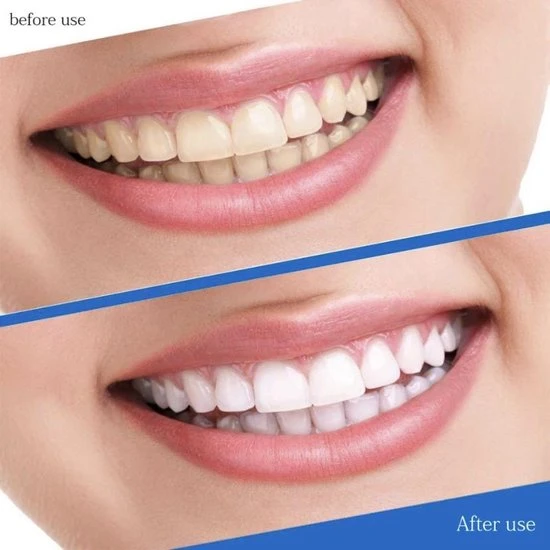 Groothandel ???? SmileKit Teeth Whitening Strips - Tanden Bleken - Tandenbleekset - Tandenbleek Strips - 100% Natuurlijk/Vegan - 28x Tandenbleek Strips - (0%) Peroxide - Activated Houtskool & Kokosolie - Beauty - Frisse Adem ???? 6 Groothandel ???? SmileKit Teeth Whitening Strips - Tanden Bleken - Tandenbleekset - Tandenbleek Strips - 100% Natuurlijk/Vegan - 28x Tandenbleek Strips - (0%) Peroxide - Activated Houtskool & Kokosolie - Beauty - Frisse Adem ???? - Afbeelding 6
